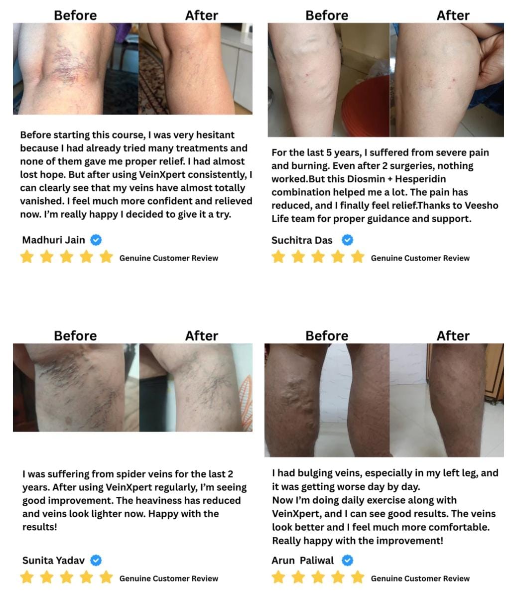 Ayurvedic VeinXpert Tablets – Varicose Veins | Support for Vein Health, Blood Circulation & Leg Comfort
