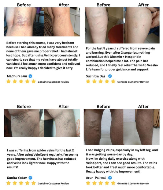 Ayurvedic VeinXpert Tablets – Varicose Veins | Support for Vein Health, Blood Circulation & Leg Comfort